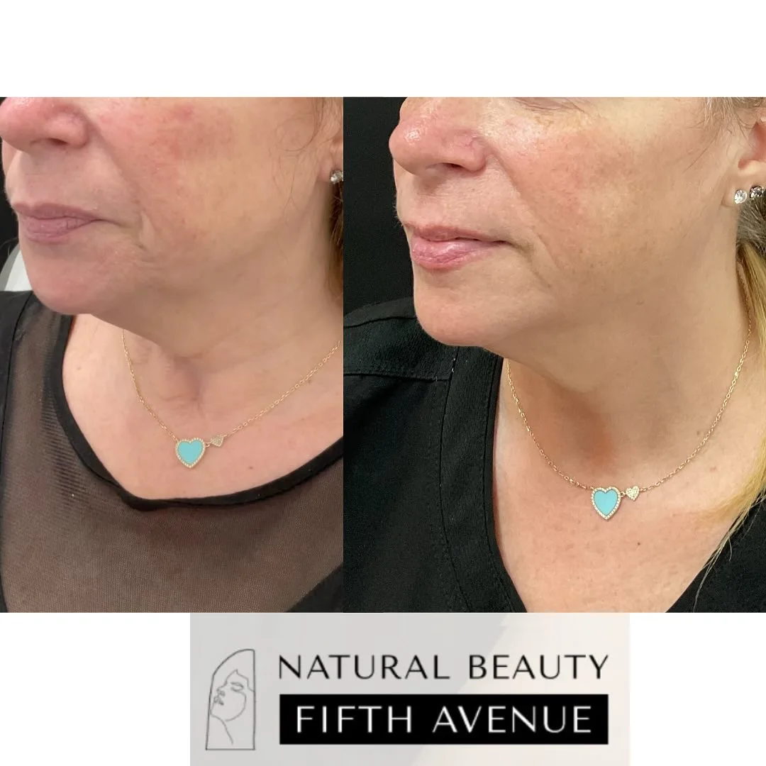 Before and after side profile showing improved jawline definition and skin tightness from K Luxe Tightlift treatment